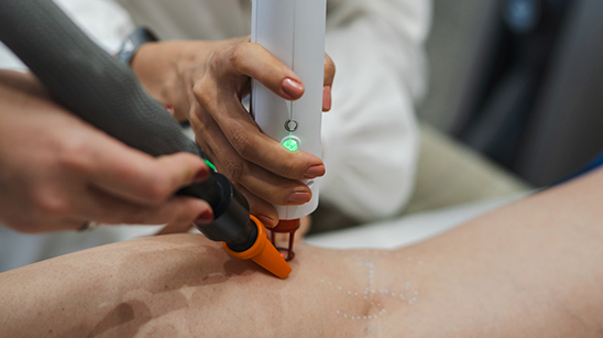 Aplicação de laser durante procedimento vascular na perna