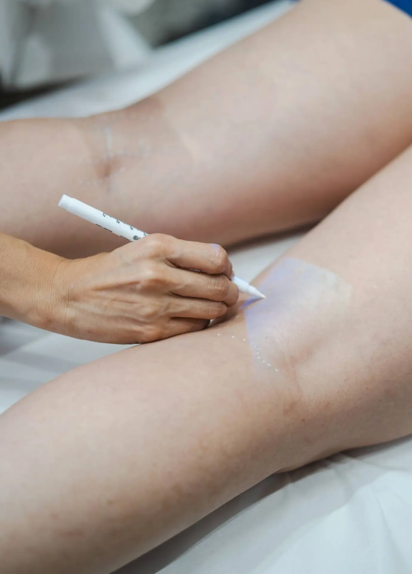 Marcação do trajeto das veias na perna antes do procedimento