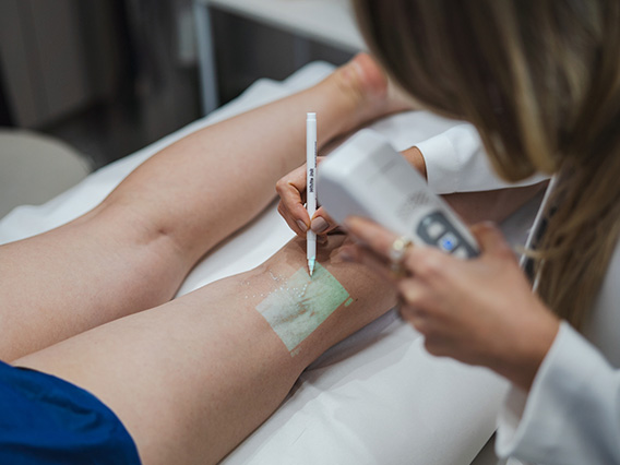 Marcação do trajeto das veias na perna da paciente com auxílio de transiluminação na Vein Vitae
